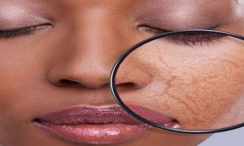 لایه برداری، پاکسازی یا جوانسازی؟ لایه برداری، پاکسازی یا جوانسازی؟