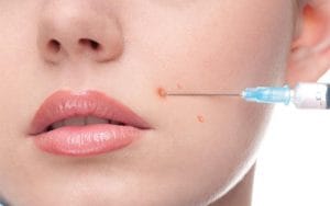 از بین بردن جوش برای همیشه ممکنه؟ | بله! با مزوتراپی برای جوش صورت Acne Spot Injection min 300x188 - از بین بردن جوش برای همیشه ممکنه؟ | بله! با مزوتراپی برای جوش صورت