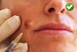 از بین بردن جوش برای همیشه ممکنه؟ | بله! با مزوتراپی برای جوش صورت getty rf photo of doctor injecting womans acne with corticosteroid1 300x204 - از بین بردن جوش برای همیشه ممکنه؟ | بله! با مزوتراپی برای جوش صورت