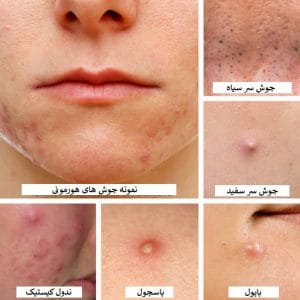 از بین بردن جوش برای همیشه ممکنه؟ | بله! با مزوتراپی برای جوش صورت unnamed 1 3 300x300 - از بین بردن جوش برای همیشه ممکنه؟ | بله! با مزوتراپی برای جوش صورت