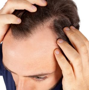 ریزش مو شدید دارم چیکار کنم | بهترین درمان ریزش مو مردان و زنان Hair Loss Treatments And Solutions For Men 295x300 - ریزش مو شدید دارم چیکار کنم | بهترین درمان ریزش مو مردان و زنان