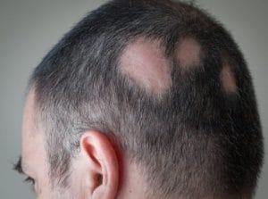ریزش مو شدید دارم چیکار کنم | بهترین درمان ریزش مو مردان و زنان alopecia areata 300x223 - ریزش مو شدید دارم چیکار کنم | بهترین درمان ریزش مو مردان و زنان