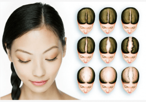 ریزش مو شدید دارم چیکار کنم | بهترین درمان ریزش مو مردان و زنان hair loss in women images 300x211 - ریزش مو شدید دارم چیکار کنم | بهترین درمان ریزش مو مردان و زنان