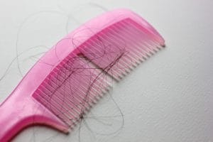 ریزش مو شدید دارم چیکار کنم | بهترین درمان ریزش مو مردان و زنان what causes female hair loss 300x200 - ریزش مو شدید دارم چیکار کنم | بهترین درمان ریزش مو مردان و زنان