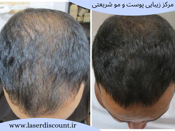 عکس قبل و بعد از درمان ریزش مو