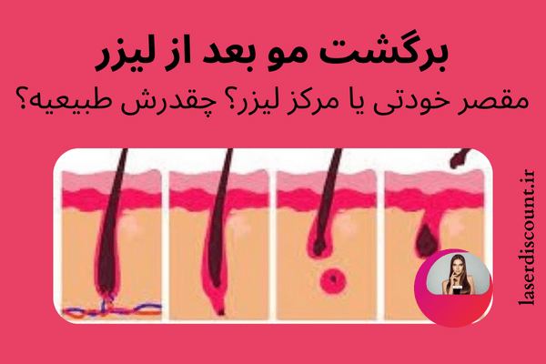 برگشت مو بعد از لیزر
