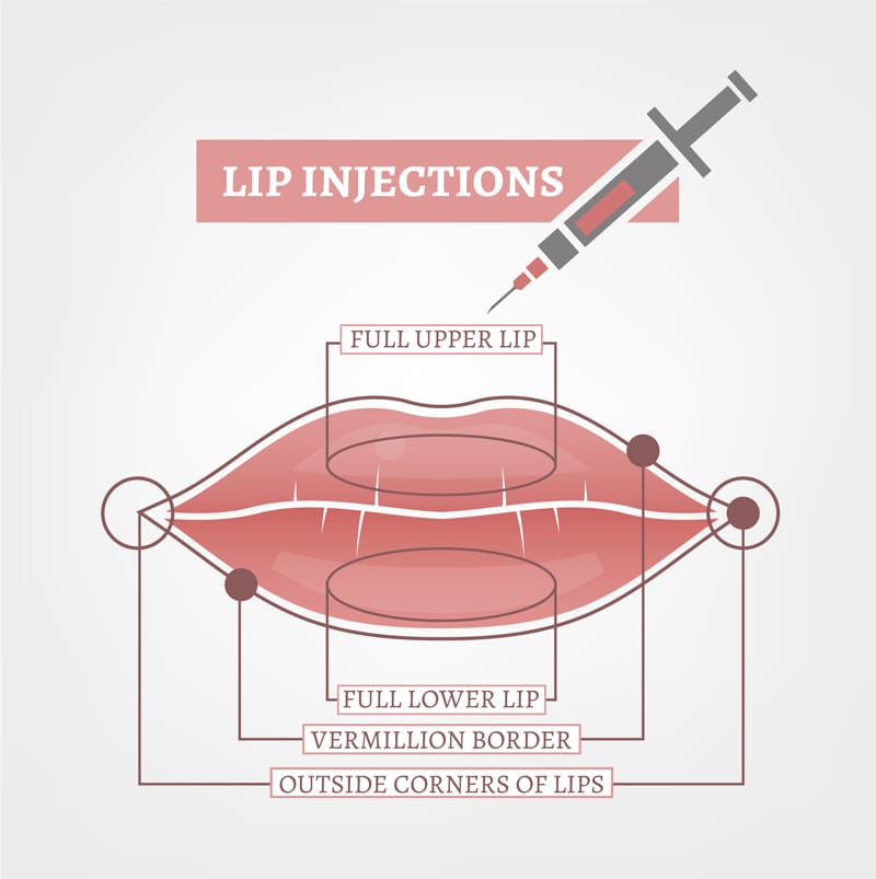 LipFillerDublinGoldenRatioInfographic مرکز لیزر موهای زائد در تهران