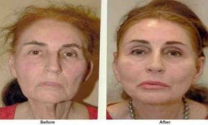 عکسهای قبل و بعد هایفو