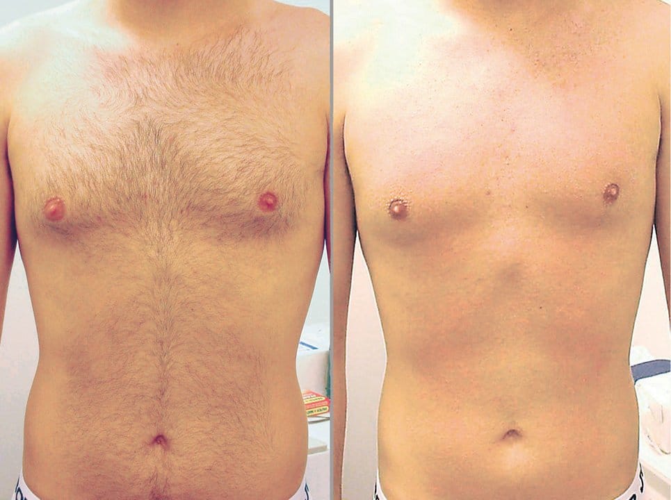 body hair removal for men