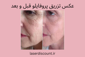 عکس تزریق پروفایلو قبل و بعد