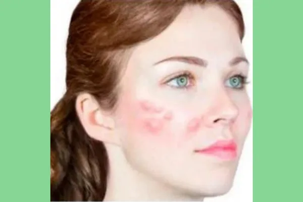 درمان گلوله شدن ژل صورت